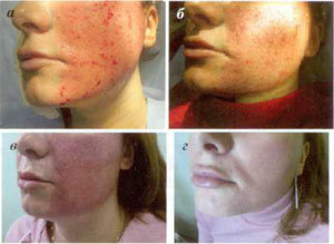 Stages of skin restoration after fractional ablation