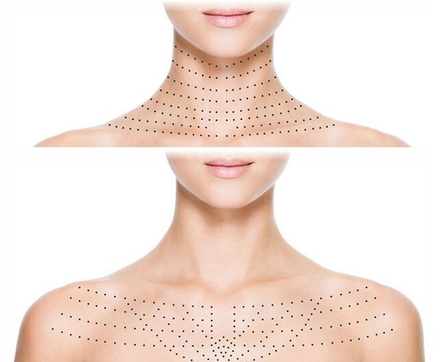 Marking on the skin of the neck and décolleté for rejuvenating bio-revitalization