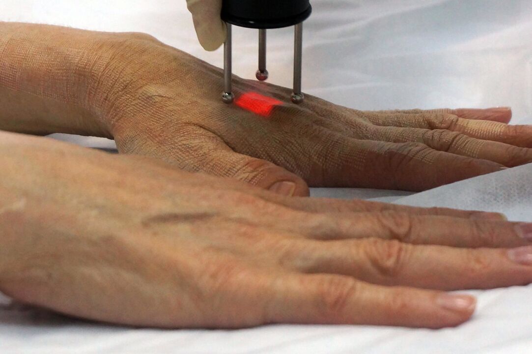 Laser rejuvenation of the hands using a non-ablative method