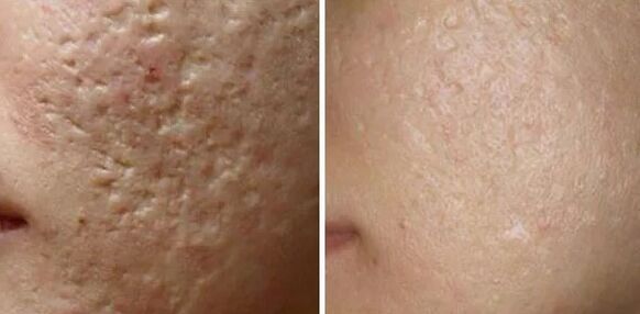Laser loop of scars