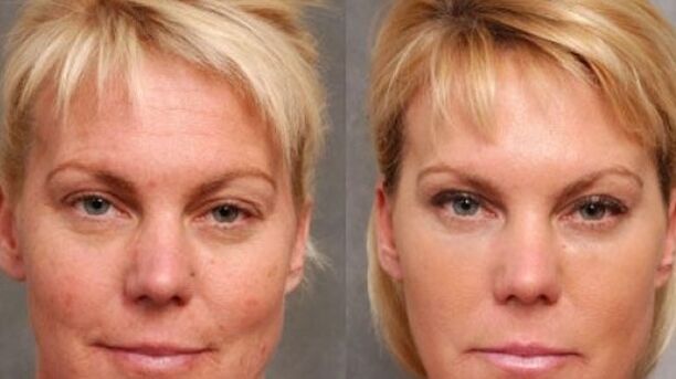 Before and after the rejuvenation procedure