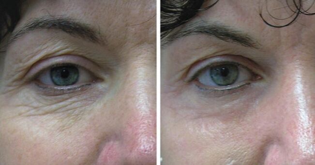 Skin laser around the eyes